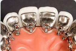 aparat dentar lingual Incognito
